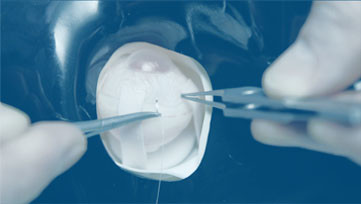 Corneal surgery