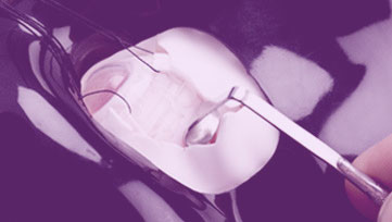 Vitreoretinal surgery