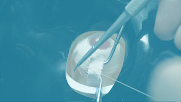 Cirugía de glaucoma