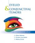 Eyelid & conjunctival tumors