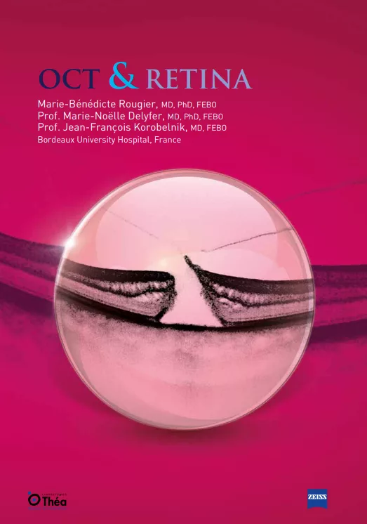 OCT and retina: a comprehensive guide to  a macular disease diagnostics